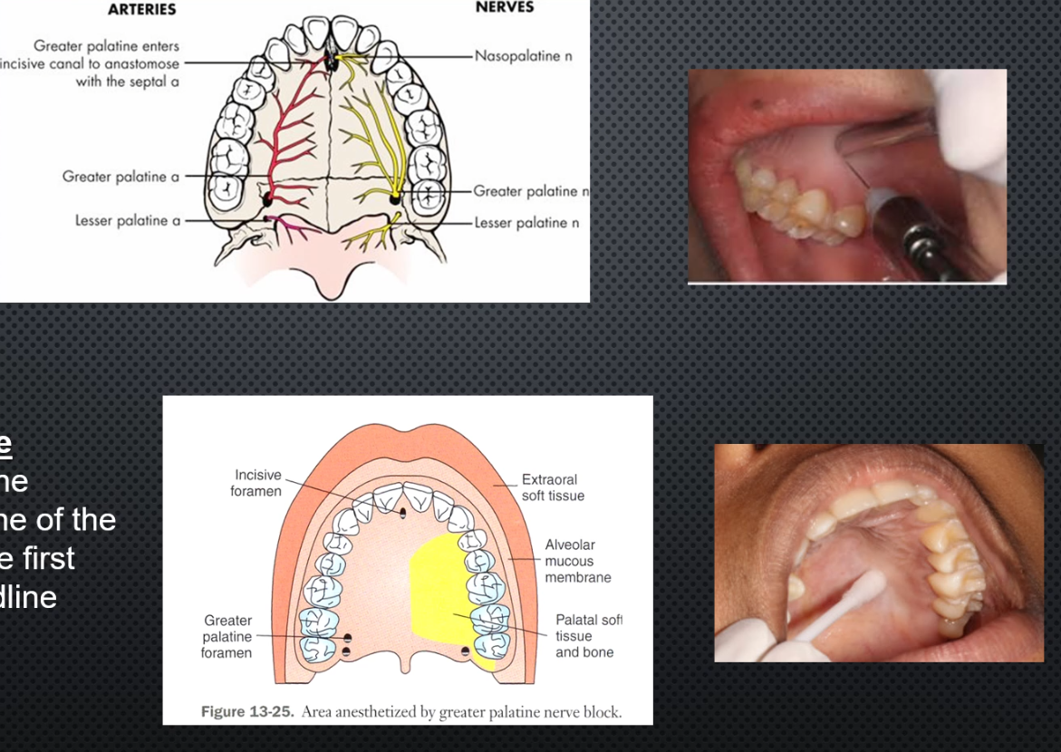 <ul><li><p>Area anesthetized: palatal mucosa behind maxillary premolars and molars</p></li><li><p>Procedure: Insert needle slightly anterior to greater Palatine Foramen until contacting bone, deposit 0.5ml (or until blanching)</p></li><li><p>Onset of action:3-5 min</p></li><li><p>Apply pressure at site before and during injection</p></li><li><p>Amount of anesthetic: 0.45-0.6 or blanching</p></li></ul><p></p>