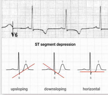 <p>inverted T waves and ST segment can upslope, downslope or be horizontal. </p>