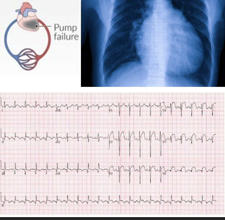 <ul><li><p><mark data-color="yellow" style="background-color: yellow; color: inherit">Myocardial infarction (#1)</mark></p></li><li><p>Heart failure</p></li><li><p>Dysrhythmias</p></li><li><p>Coronary artery disease</p></li><li><p>Cardiomegaly </p></li><li><p>Myocarditis</p></li><li><p>Cardiac valve disorders</p></li><li><p>Drug toxicity </p></li></ul><p></p>