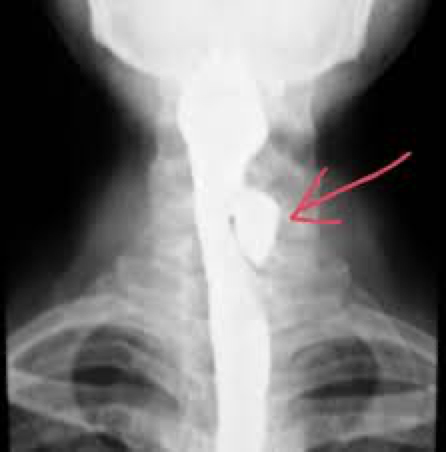 <p>upper esophagus</p>