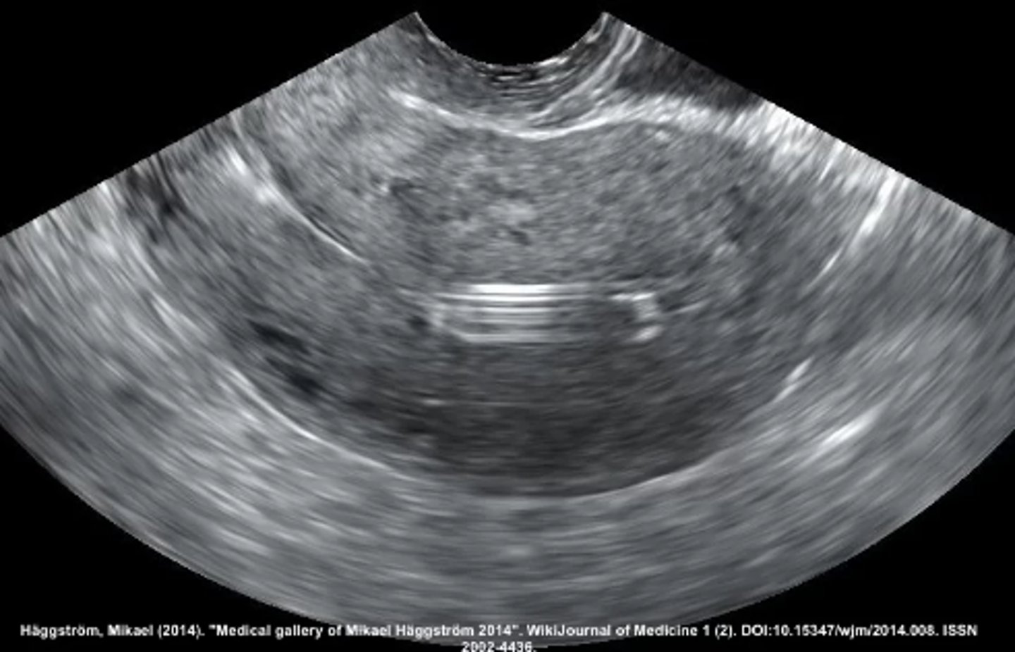 <p>Intrauterine device</p><p>-IUD are hyperechoic with reverberation artifact posteriorly. Some IUDs may also show posterior shadowing</p>