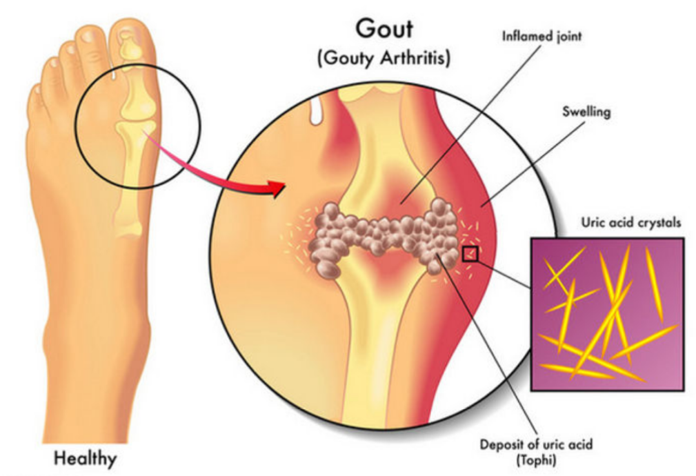<p><span style="color: blue">increased uric acid in plasma deposits around joints</span> (commonly <strong>big toe</strong>) + develops <span style="color: #15b8d8"><strong>sharp, painful Uric acid <u>crystals</u></strong></span></p>