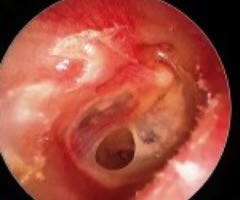<p>tear in the tympanic membrane caused by either infection, trauma, rapid changes in pressure</p>