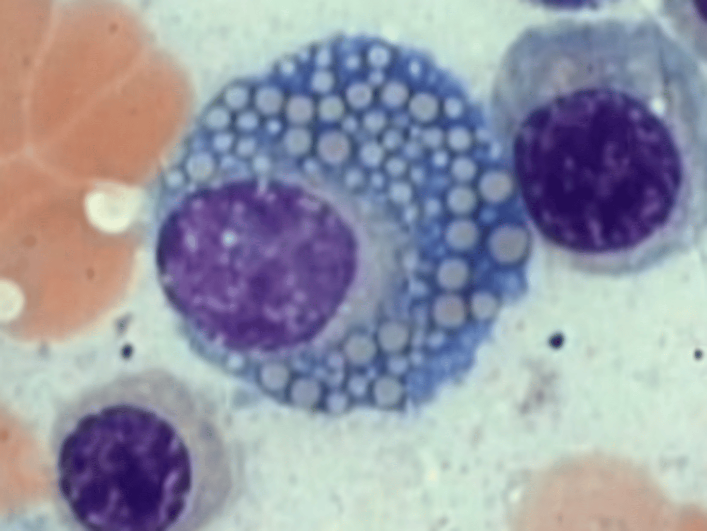 <p>Plasma cell variation</p><p>Numerous globules filling the cytoplasm, and these represent aggregates of immunoglobulins that are produced by that plasma cell</p>