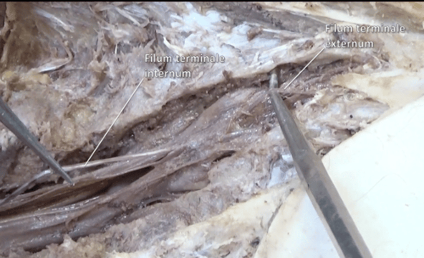 <p>anchors spinal cord to coccyx located inside the cauda equina</p>