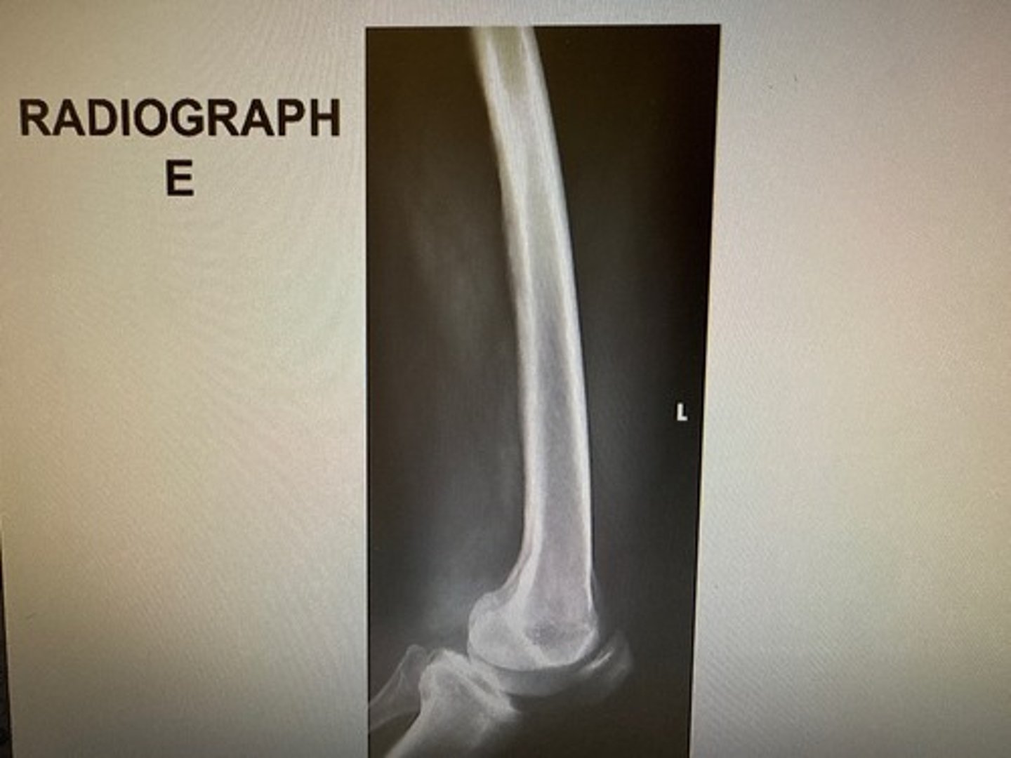 <p>Choose three reasons why the inferior condyles are not SI on this image:</p><p>The med condyle is inferior to the lat condyle</p><p>Poor positioning</p><p>No angle on the CR</p><p>Poor centering</p><p>The divergence of the beam</p>
