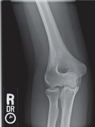 <p><strong>In which of the following projections was the image in Figure 6-1 made?</strong></p><p><strong>A)</strong> AP<br><strong>B)</strong> Medial/internal oblique<br><strong>C)</strong> Lateral/external oblique<br><strong>D)</strong> Acute flexion</p>