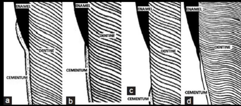 <p>cementum overlapping enamel</p>