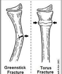 <p>Torus, greenstick (incomplete)</p>
