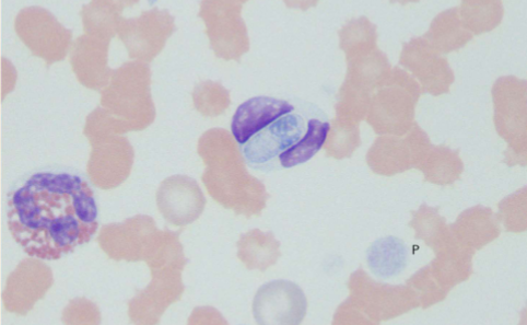 <p>Subclinical to fever, depression, and bone disease</p>