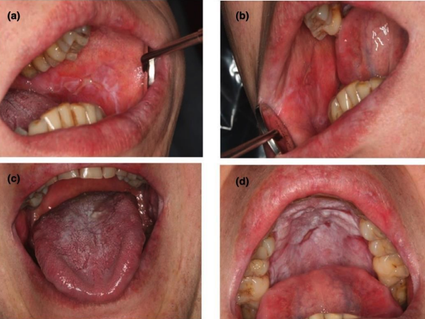 <p>Oral Graft-versus-Host Disease (GvHD)</p>