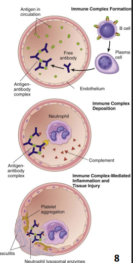 <p>Pathogenesis of Glomerulonephritis:</p><ul><li><p>Immune complex deposition or other causes of glomerular damage</p></li><li><p>Recruitment of immune cells</p></li><li><p>Damage to _________ BM → BM thickening → scarring → decreased GFR </p></li><li><p> Proteinuria and/or hematuria</p></li></ul><p></p>