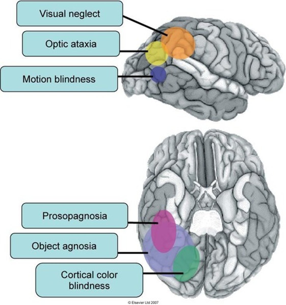 <p>Cortical achromatopsia is a visual disorder associated with damage to area V4, resulting in the inability to perceive color.</p>