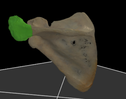 <p>laterale uiteinde van spina scapula dat verbindt met clavicula</p>