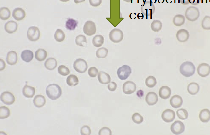 <ul><li><p>RBC’s with decreased color</p></li><li><p>periphery appears darker, gradually lose color in central region</p></li><li><p>vary pale central region</p></li><li><p>insufficient hemoglobin in cell</p><ul><li><p>iron deficiency </p></li></ul></li></ul><p></p>