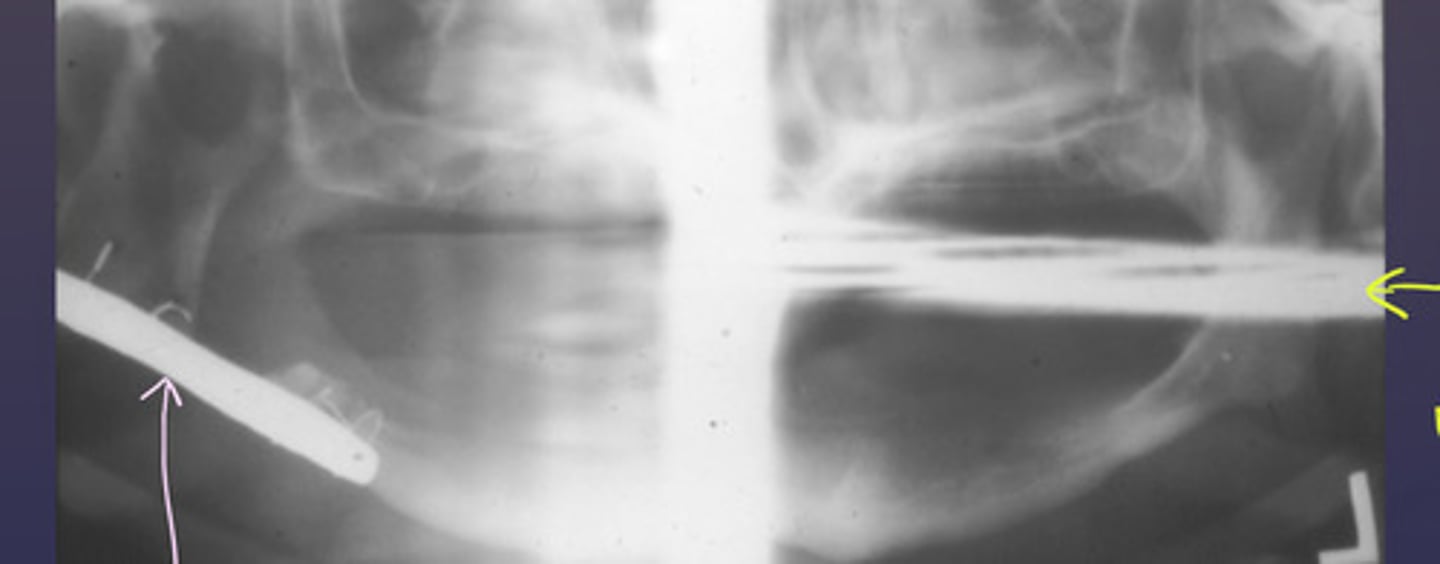<p>the following patient has a surgical plate. What type of image is the purple arrow pointing to?</p>
