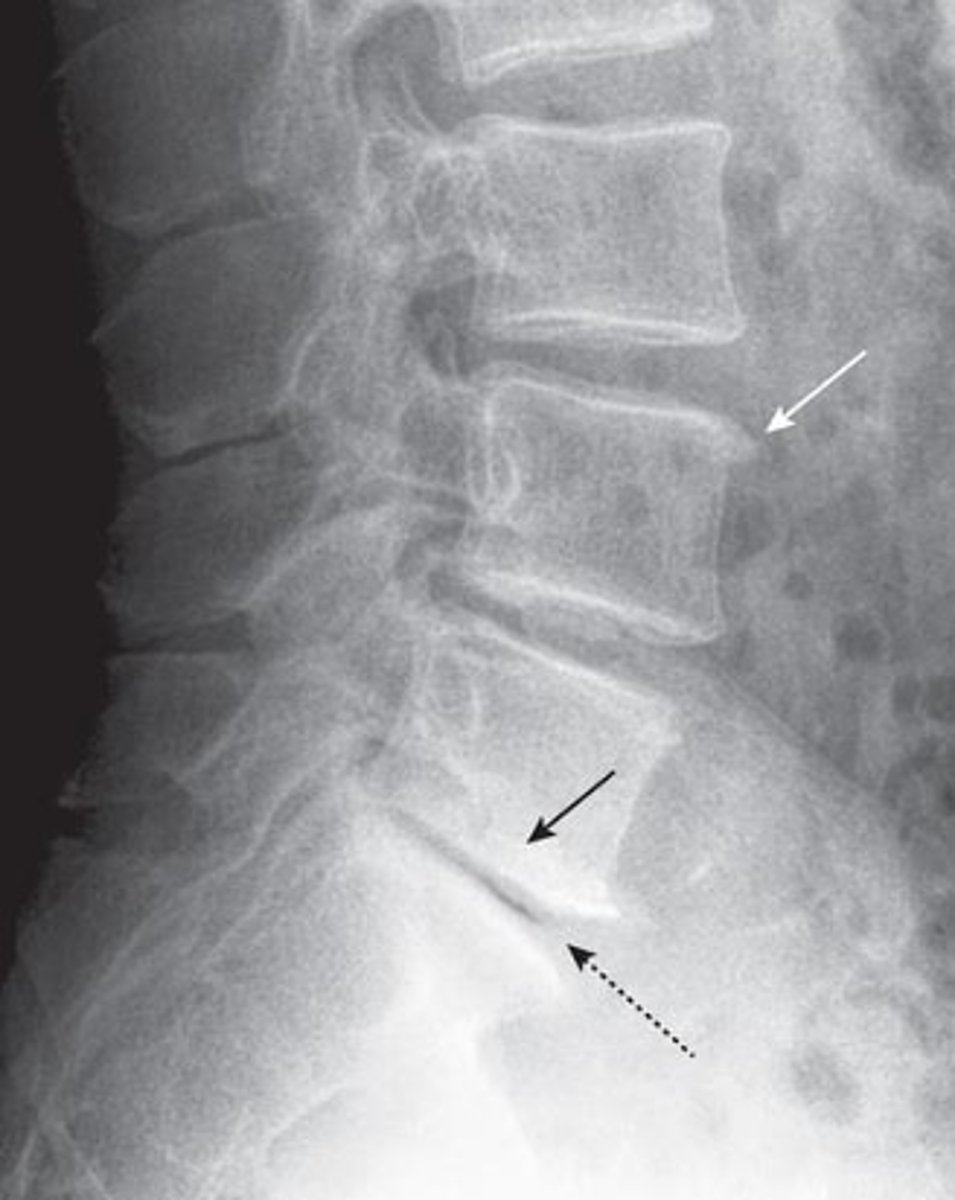 <p>What pathology is seen here?</p>