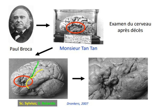 Dans le cerveau, le langage dépend d’un réseau neuronal localisé dans un hémisphère cérébral : image 1
La corrélation anatomo-clinique classique : image 2
Monsieur Tan Tan a une lésion sûrement due à la syphilis.