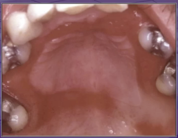 <p>what is the cause of this lesion </p><p>wearing denture all the time </p><p>trauma </p><p>bacterial infection </p><p>unknown </p>