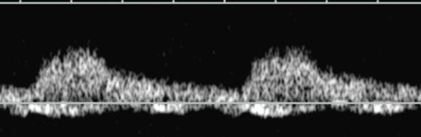 <p>Rounded/delayed upstroke - indicates high grade stenosis proximally</p><p>100% indicative of RAS, but not always seen in RAS patients</p><p>Measured by acceleration time or acceleration index</p>