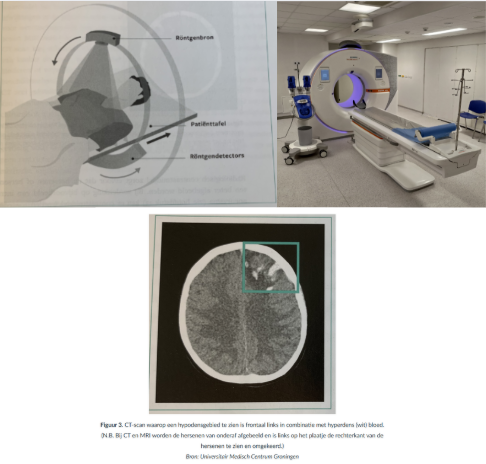 <p><strong>Algemeen</strong></p><ul><li><p>Een CT-scan maakt <strong>dwarsdoorsneden </strong>van de hersenen met behulp van <strong>röntgenstralen </strong>en een computer.</p></li><li><p>Het is <strong>snel en volledig</strong>, geschikt voor het opsporen van een <strong>acuut herseninfarct of hersenbloedingen.</strong></p></li><li><p>Door de ontwikkeling van CT werd het mogelijk hersenweefsel in <strong>korte tijd gedetailleerd</strong> te tonen.</p></li></ul><p><strong>Overige opmerking</strong> </p><ul><li><p>CT- en MRI-beelden tonen hersenen van onderaf:</p><ul><li><p>Linkerzijde van de afbeelding is de rechterkant van de hersenen.</p></li></ul></li></ul><p></p>