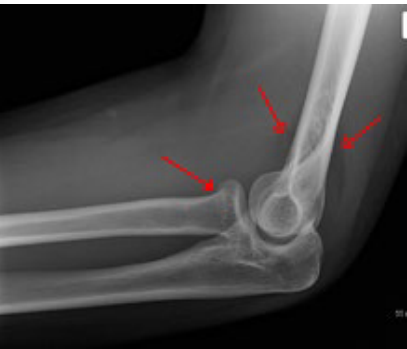 <p><strong>Fat Pad Sign</strong> </p><p>-Anterior → “Sail sign”, usually indicates a radial ____ or distal __________ fracture </p><p>-Posterior </p>