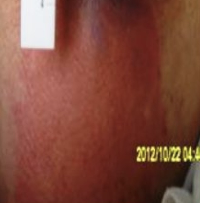<p>Intact skin with non-blanchable redness over a bony prominence </p>