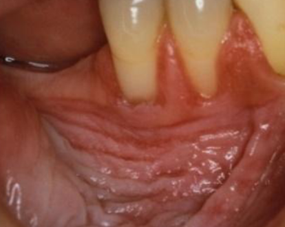 <p>precancerous white lesion due to chewing tobacco </p>