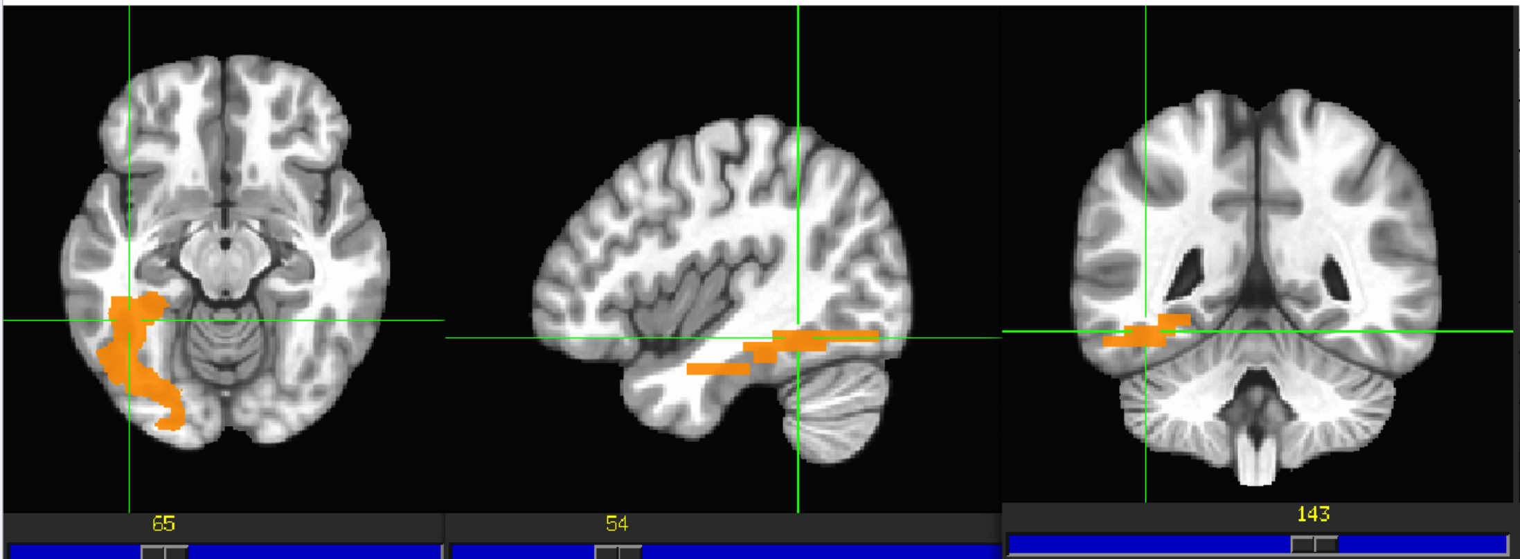 <p>(Part of the “WHAT” pathway) both left hemisphere and right are important for processing <u>human faces</u>, but the left one is also important for the <u>recognition of words</u></p>