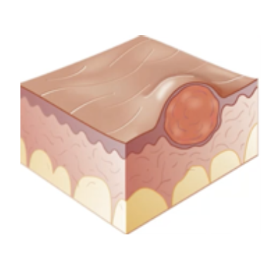 <p>Primary Skin Lesion</p><ul><li><p><strong>Raised</strong> lesion of <strong>less than 0.5 cm</strong> with <strong>circumscribed border</strong></p></li><li><p>E.g. wart</p></li></ul><p></p>