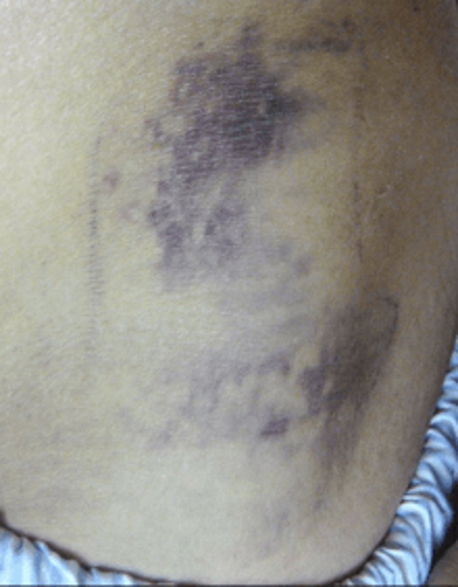 <p>reddish-brown discoloration along flanks resulting from retroperitoneal blood dissecting tissue planes</p>