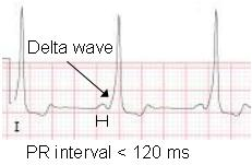 <p>What does this EKG show?</p>