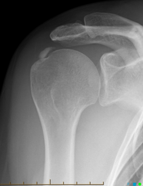 <p>Calcific tendinopathy - Supraspinatus has a calcium deposit buildup in rotator cuff tendon, is a result of</p>