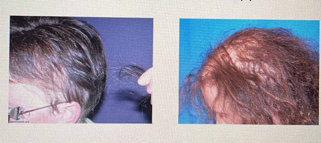 <p>HAIR DISORDER</p><p><span style="font-family: Calibri, sans-serif"><strong>Anagen effluvium</strong>: Loss of hair during its growth phase; this often occurs during medical treatments like chemotherapy</span></p>