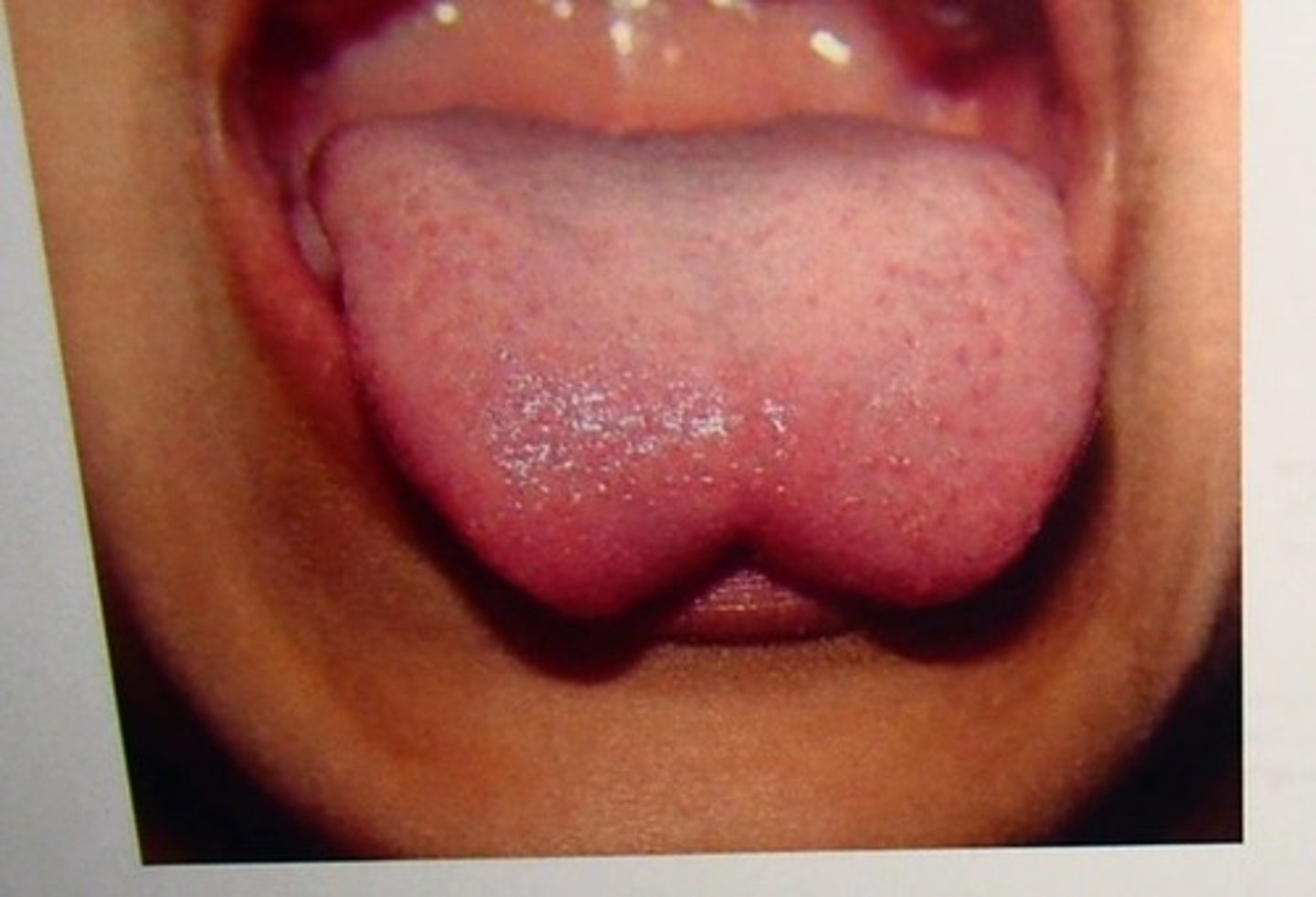 <p>Failure of tongue swellings to fully fuse.</p>