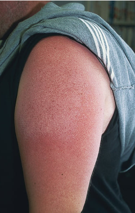 <ul><li><p>Superficial Partial Thickness</p></li><li><p>Epidermis only, quick healing.</p></li></ul><p></p>