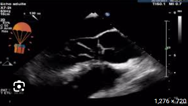 <p>cause of stenosis&nbsp;</p><p>both valves attached to the same pap muscle&nbsp;</p>