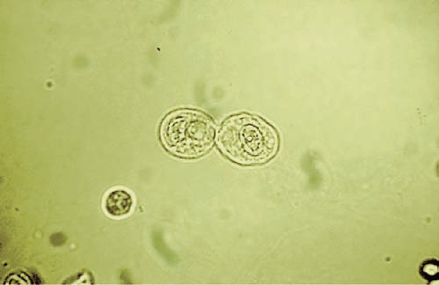 <p>Rectangular, columnar, round, oval or, cuboidal with an eccentric nucleus possinly bilirubin-stained or hemosiderin-laden</p><p>(reported as: average number per 10 hpfs)</p><p>-correlations= LE, nitrite, color, clarity, protein, bilirubin and blood</p>