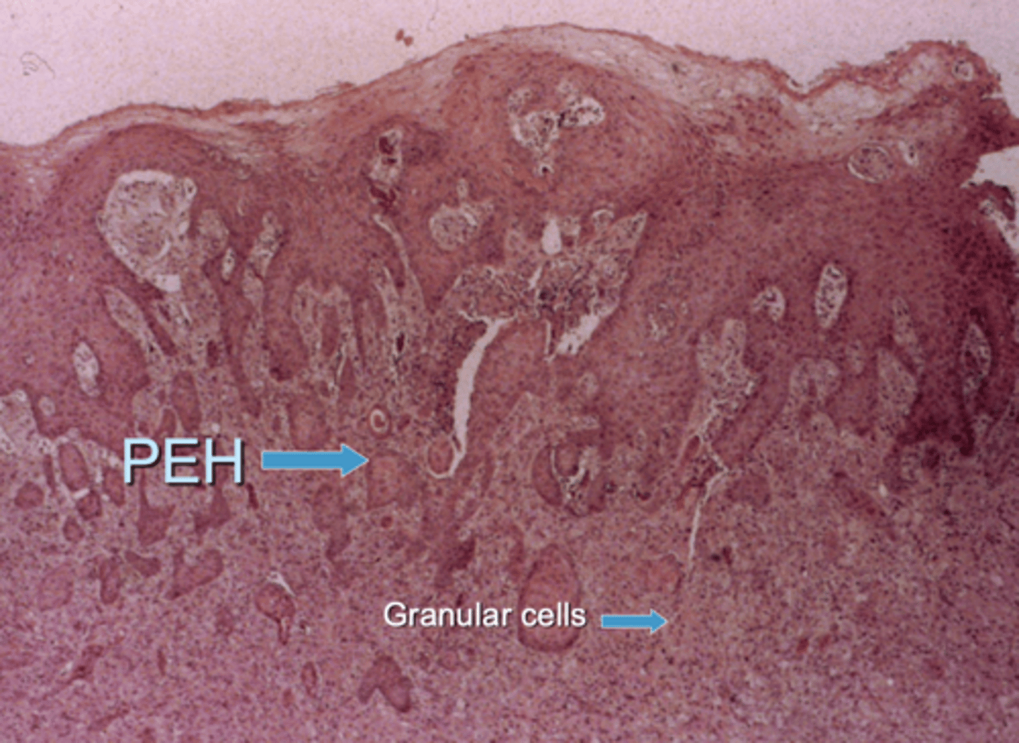 <p>pseudoepitheliomatous hyperplasia (PEH)</p><p>this can be mistaken for squamous cell carcinoma</p>
