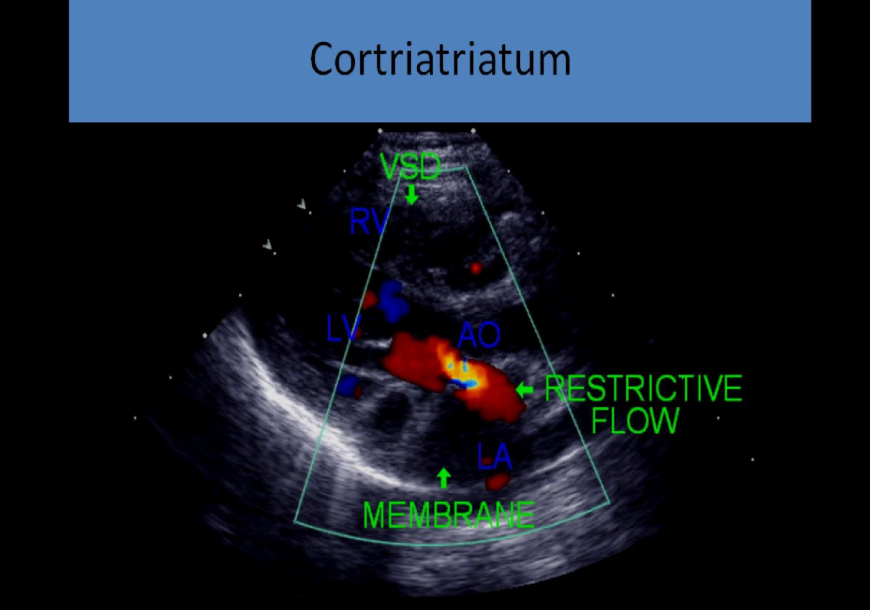 <p>suggests presence of 3 atrial chambers on 2d</p><p>can cause supravalvular stenosis</p><p>mimics mitral stenosis w turbulent flow, increased psv and ppg</p><p>dilated pulmonary veins</p><p>80% also have asd</p><p>can form in the right atrium as well but this is less common</p>