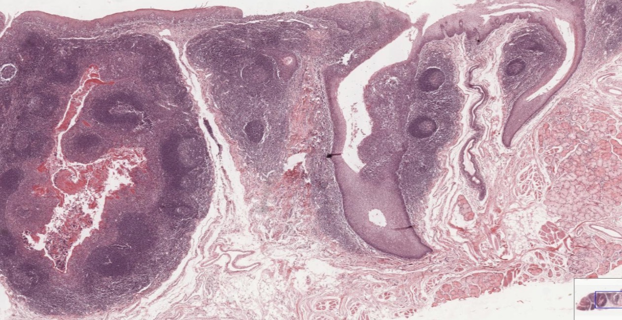 <p><span>Amígdala lingual</span></p>