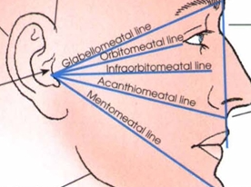 <p><span style="color: oklch(0.3039 0.04 213.68);">Mentomeatal line</span></p>