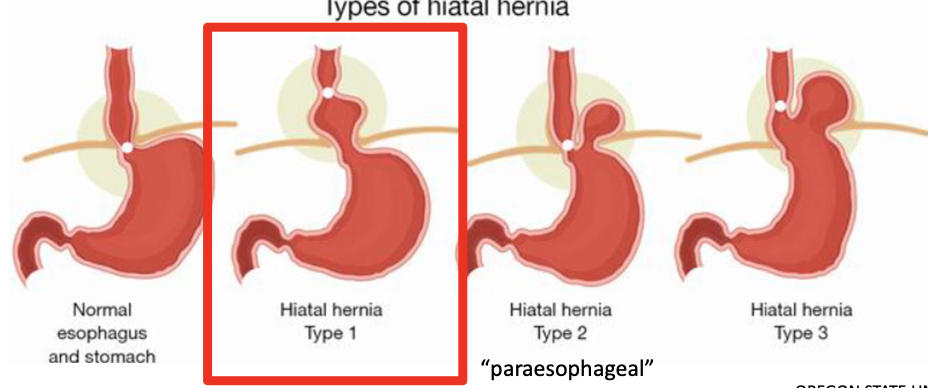 <p>protrusion of abdominal contents (usually stomach) thru the esophageal hiatus of the diaphragm</p>