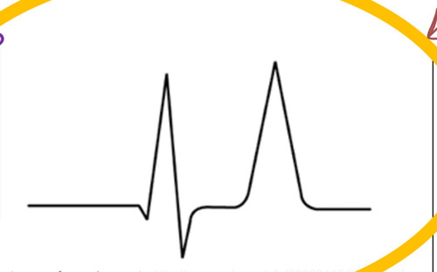 <p>What is causing this ECG?</p>