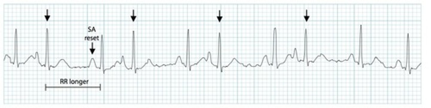 <p>Premature Atrial Complex (PAC)</p>
