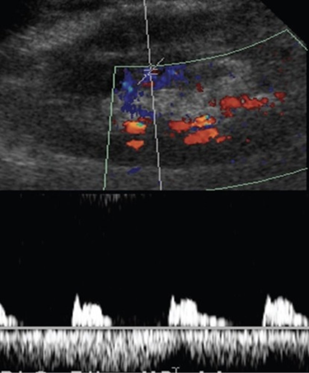 <p>Compression of kidney by fluid collections</p><p>Longlasting HTN</p><p>Blunted waveforms</p><p>Increased resistance</p>