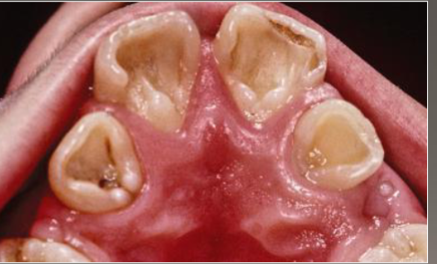 <p>promienent marginal ridges associated with dens evaginatus </p>