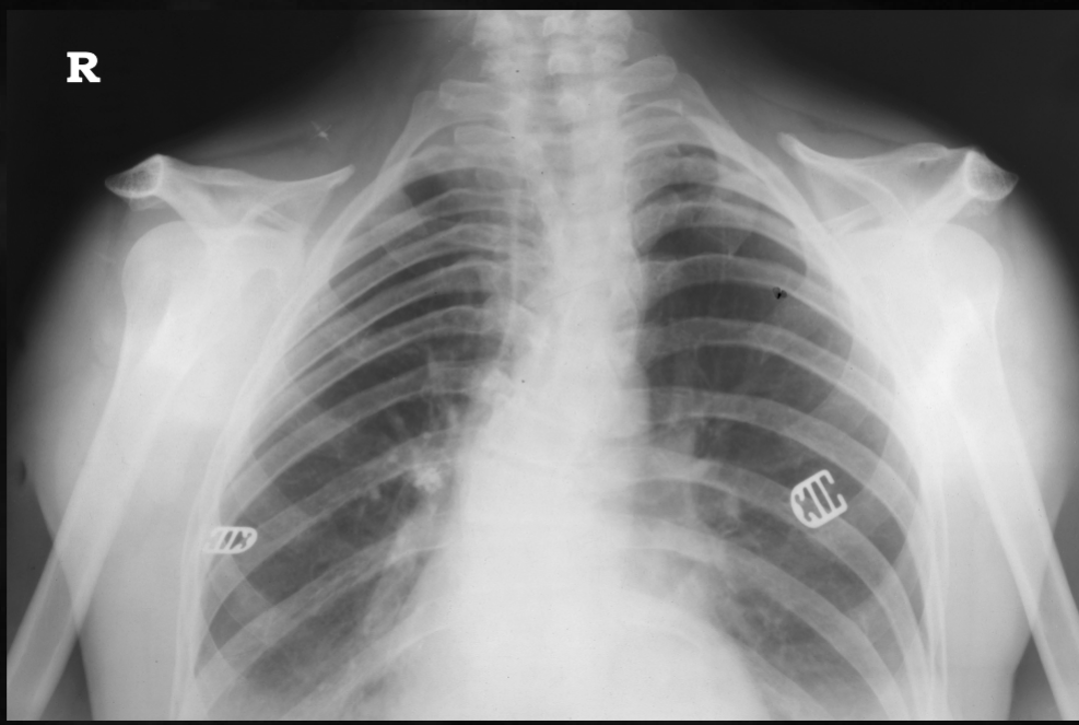 <p>what is seen here for this case of cleidocranial dysplasia?</p>