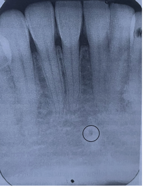 <p><span style="font-family: &quot;Times New Roman&quot;, serif">What radiolucent landmark is circled on the dental image?</span></p><ul><li><p><span style="font-family: &quot;Times New Roman&quot;, serif">mental foramen</span></p></li><li><p><span style="font-family: &quot;Times New Roman&quot;, serif">lingual foramen</span></p></li><li><p><span style="font-family: &quot;Times New Roman&quot;, serif">mandibular canal</span></p></li><li><p><span style="font-family: &quot;Times New Roman&quot;, serif">genial tubercles</span></p></li></ul><p></p>