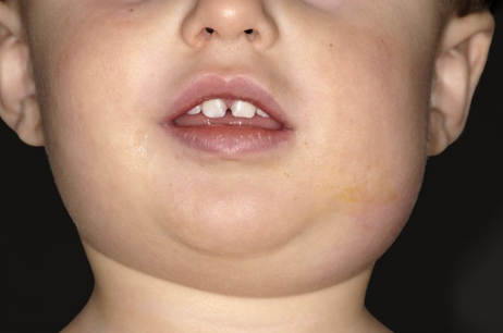 <p>In which demographic do you see mumps in?</p>